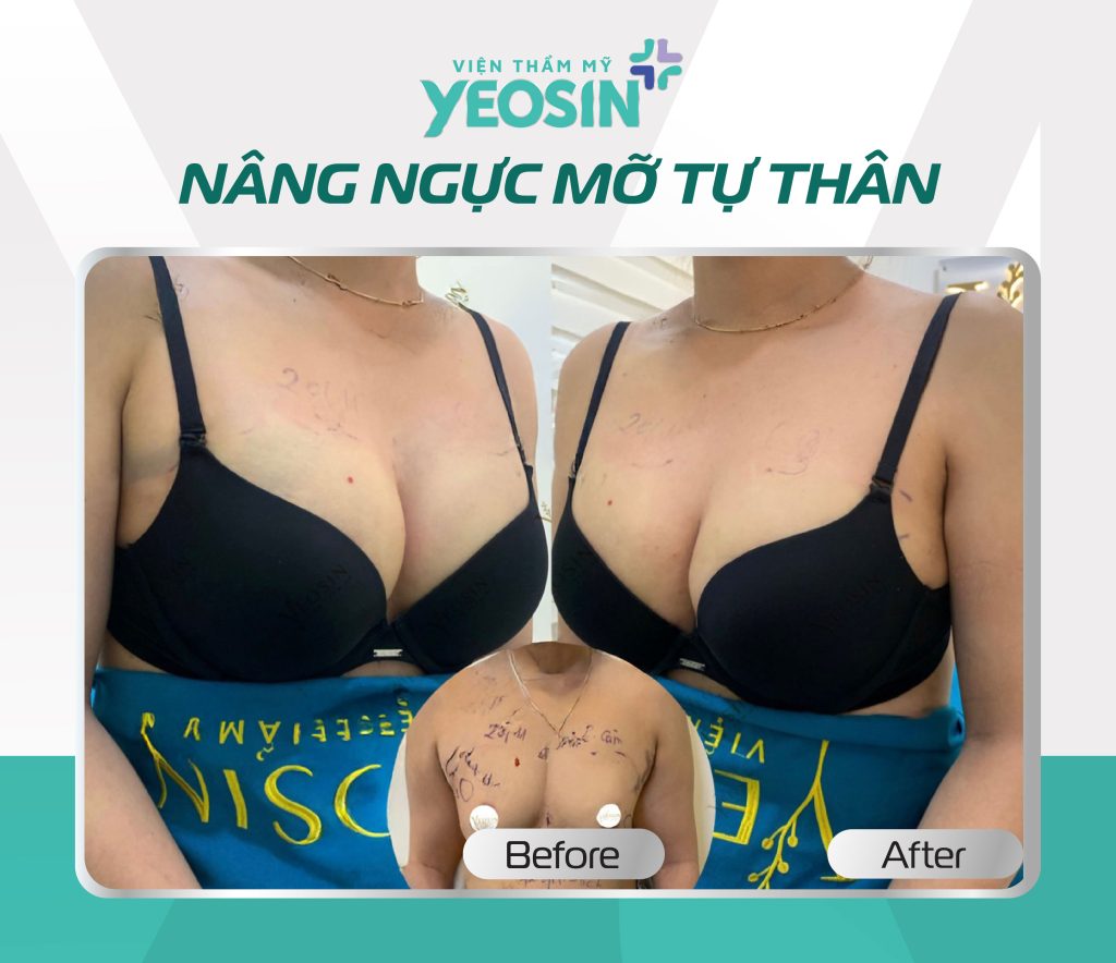 Hình ảnh trước và sau khi nâng ngực không phẫu thuật tại Yeosin