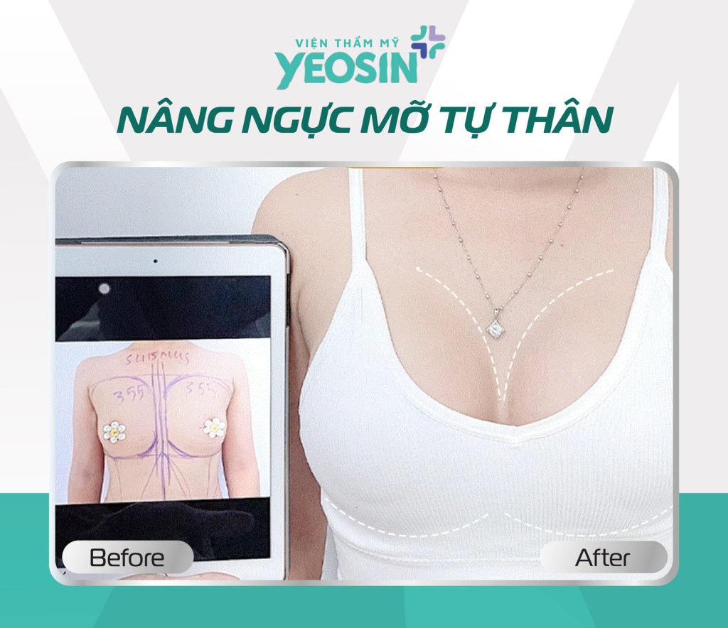 Hình ảnh trước và sau khi nâng ngực không phẫu thuật tại Yeosin