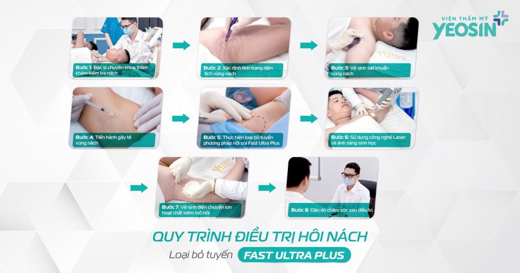 Chi tiết quy trình chữa trị hôi nách được bác sĩ chuyên khoa thực hiện
