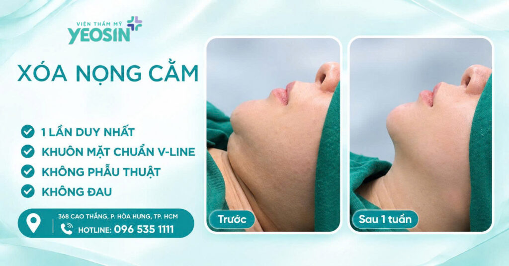 5 Cách giảm mỡ nọng cằm hiệu quả nhanh hiện nay 16 041E0986 279B 4495 BC07 961C2DA9DEB7