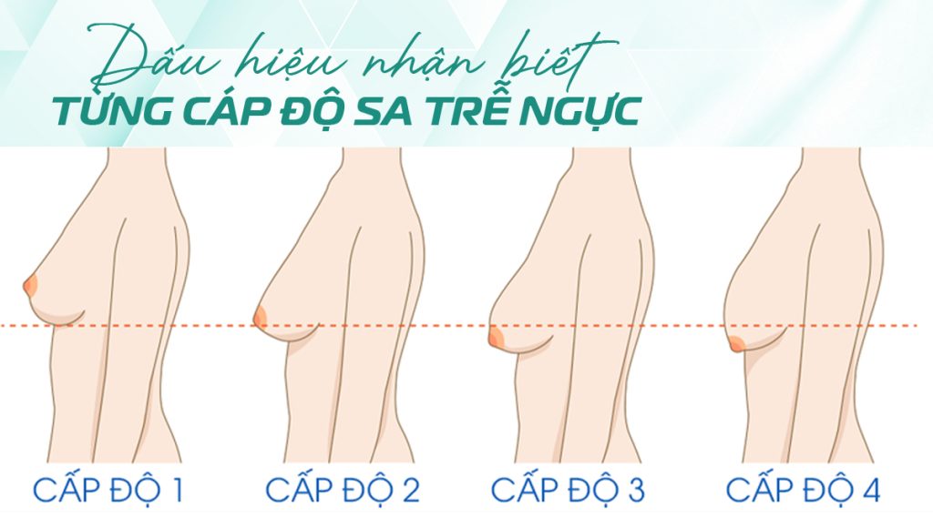 Có các mức độ sa trễ ngực nào?