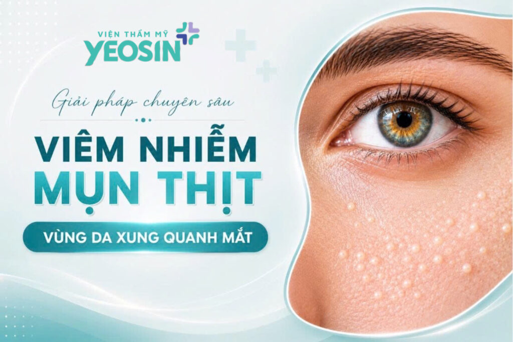 Những người có nguy cơ bị mụn thịt