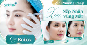 6+ Lợi ích của phương pháp xóa nhăn vùng mắt bằng Botox