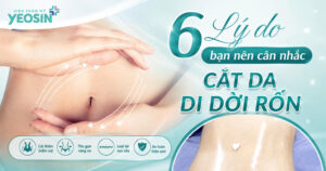 6 Lý do bạn nên cân nhắc cắt da di dời rốn
