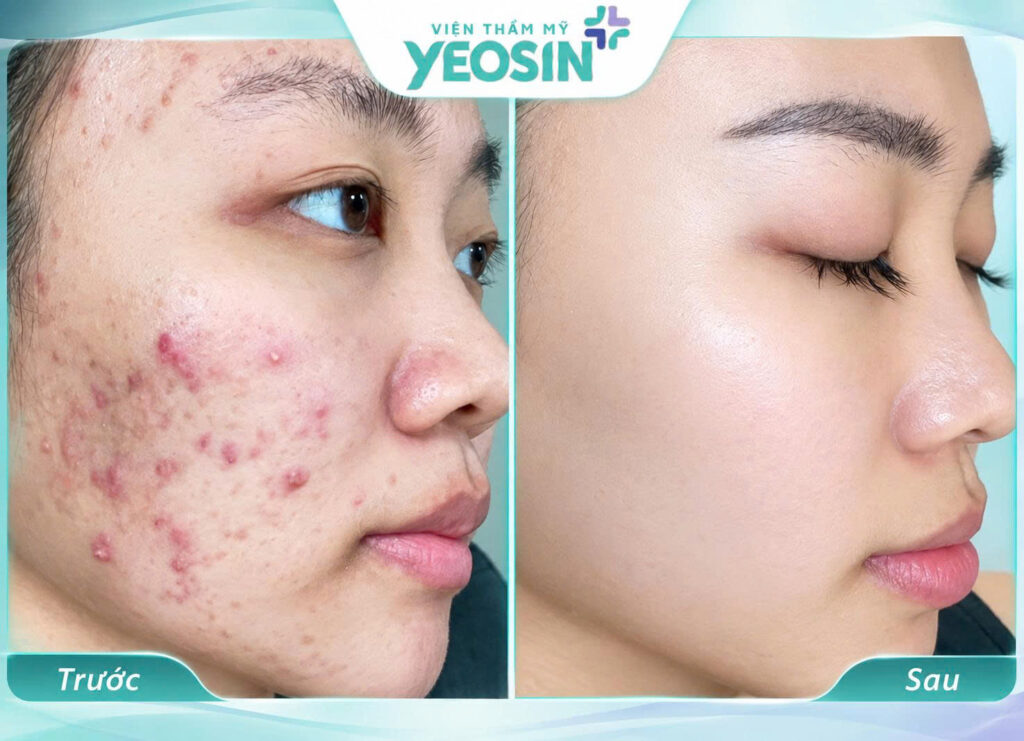 Điều trị viêm nang lông bằng Ánh Sáng Sinh Học Bio Peel 12 1789270965029 543195267361827872 301541920615582086 8422fc3f9adb4c5736082a9b903c0a8e