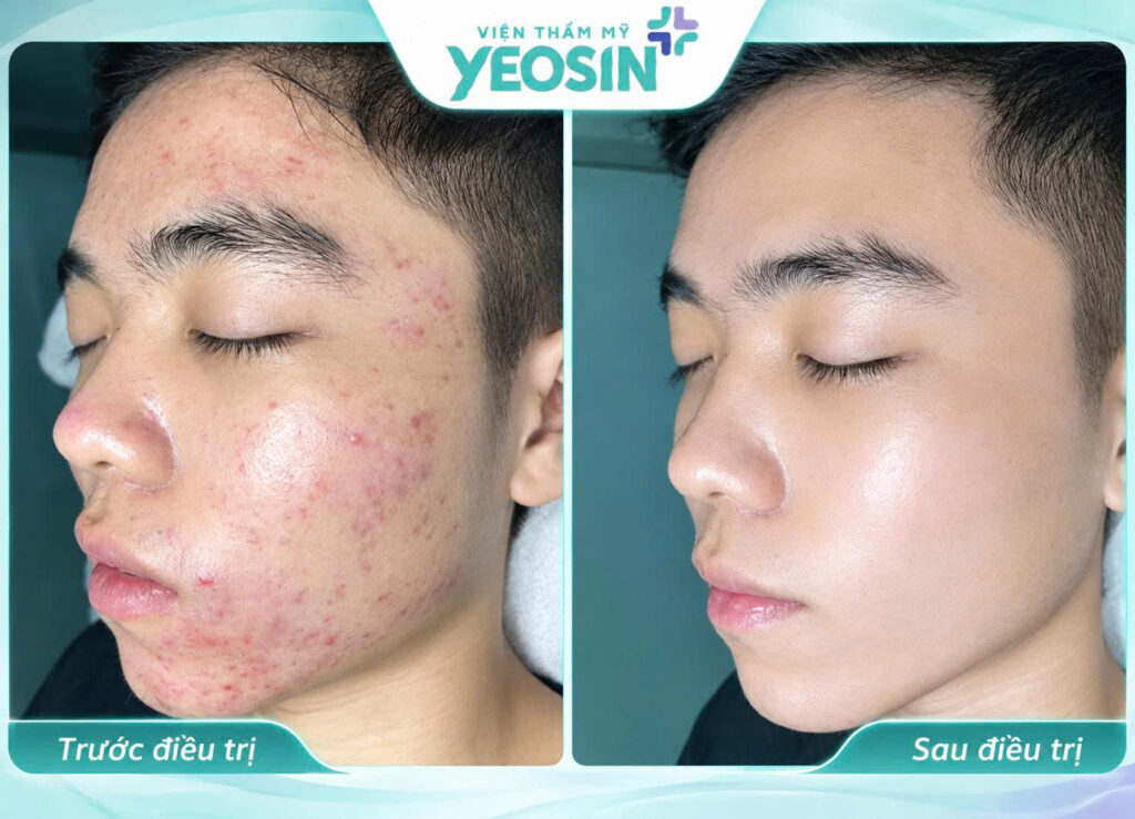Điều trị viêm nang lông bằng Ánh Sáng Sinh Học Bio Peel 13 1789271037038 543195267361827872 301541920615582086 3867040aa44ebfc01ea225f7aebcbdab