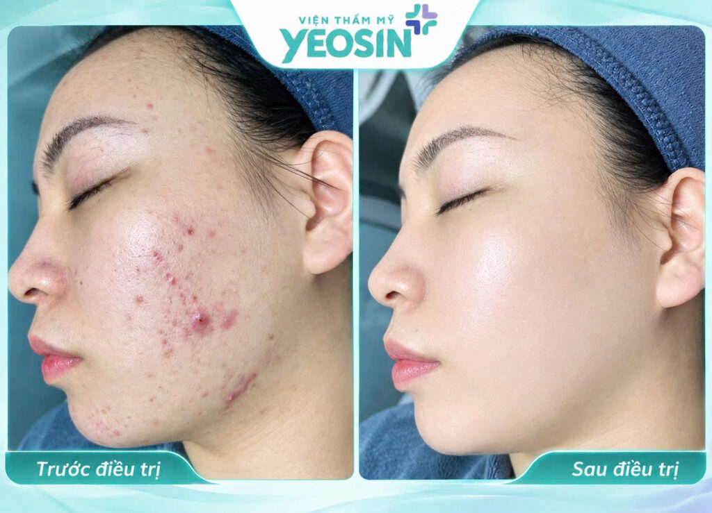 Điều trị viêm nang lông bằng Ánh Sáng Sinh Học Bio Peel 14 1789271127587 543195267361827872 301541920615582086 7deb7a3e264c334444c53946877491ea
