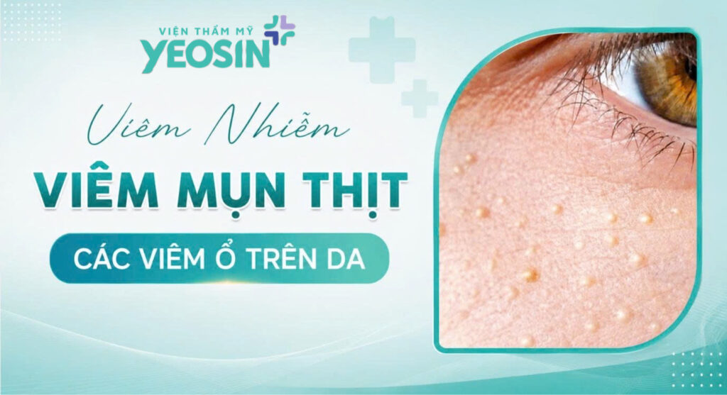 Mụn thịt đem lại nhiều rắc rối cho bạn?