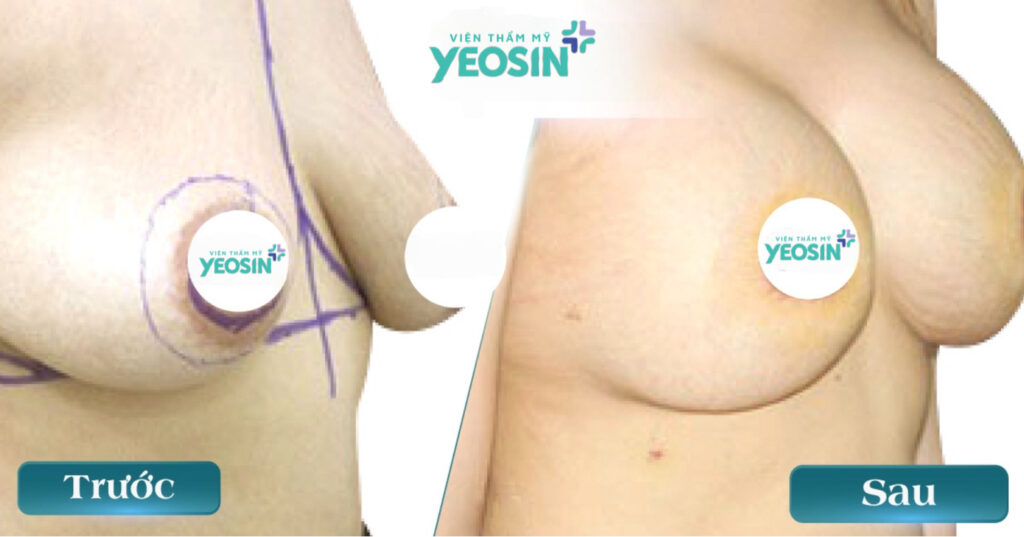 Nâng ngực - Thu gọn ngực phì đại bằng phương pháp cắt tuyến 14 3CE698C8 7F22 40D7 8735 28D41D057D98