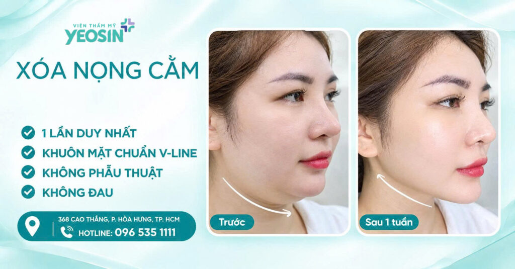 5 Cách giảm mỡ nọng cằm hiệu quả nhanh hiện nay 18 5263440D 6207 44EB 915C F896AB2A1948