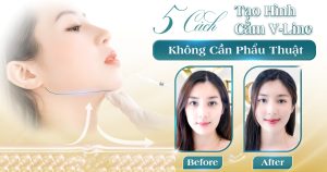 Tạo hình cằm vline viện thẩm mỹ yeosin