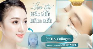 Làm đầy hốc mắt bằng HA Collagen