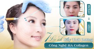 Cấy thái dương bằng HA Collagen