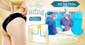 nâng mông bằng mỡ tự thân