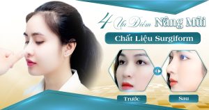 Nâng mũi Surgiform