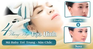 tạo hình má baby viện thẩm mỹ yeosin