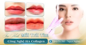 Tạo hình môi trái tim bằng HA Collagen
