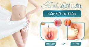 Trẻ hóa môi lớn bằng mỡ tự thân