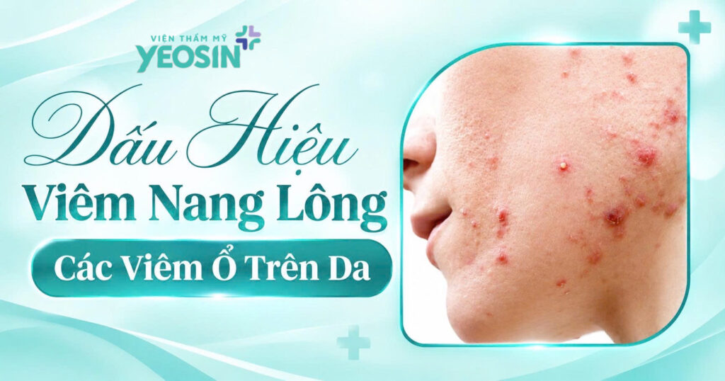 Điều trị viêm nang lông bằng Ánh Sáng Sinh Học Bio Peel 8 DB240A60 CAE7 4203 BE9E D3FA7401F5AD