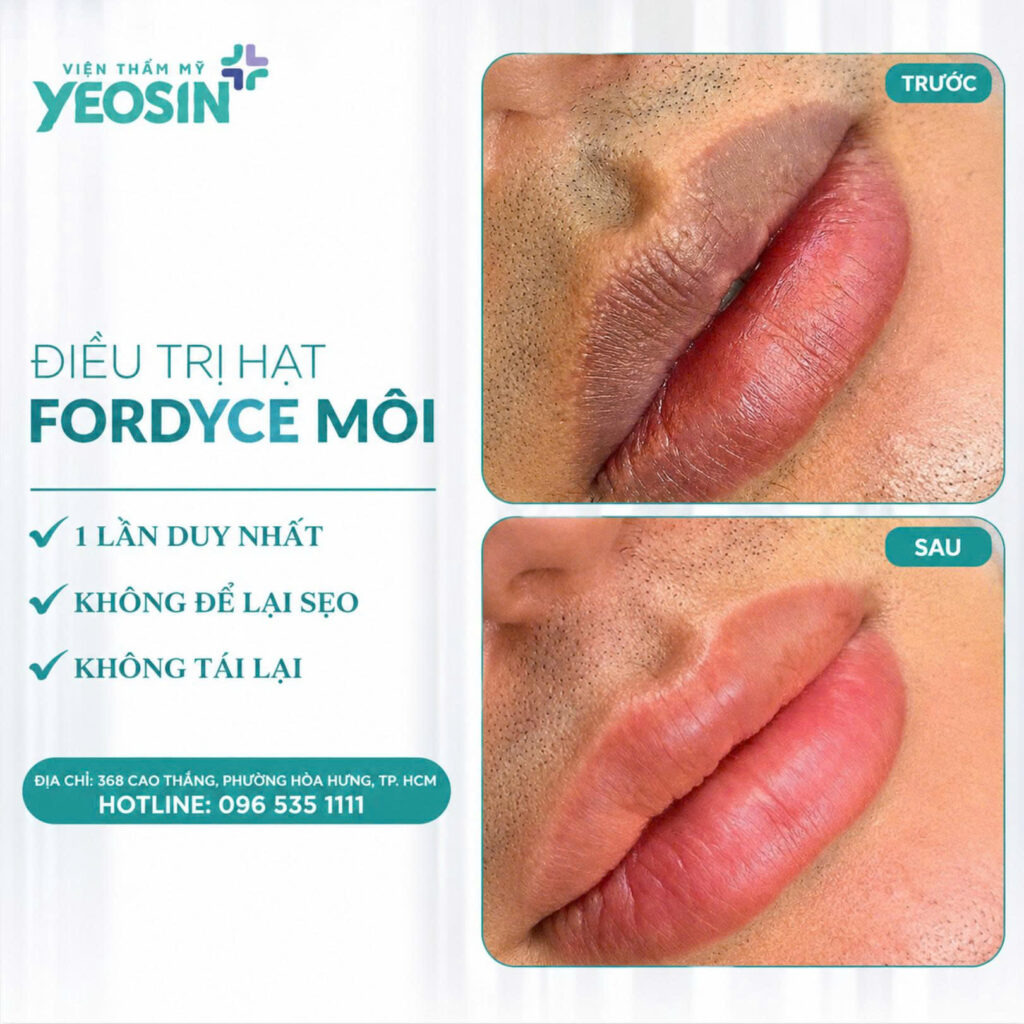Dieu tri hat fordyce moi