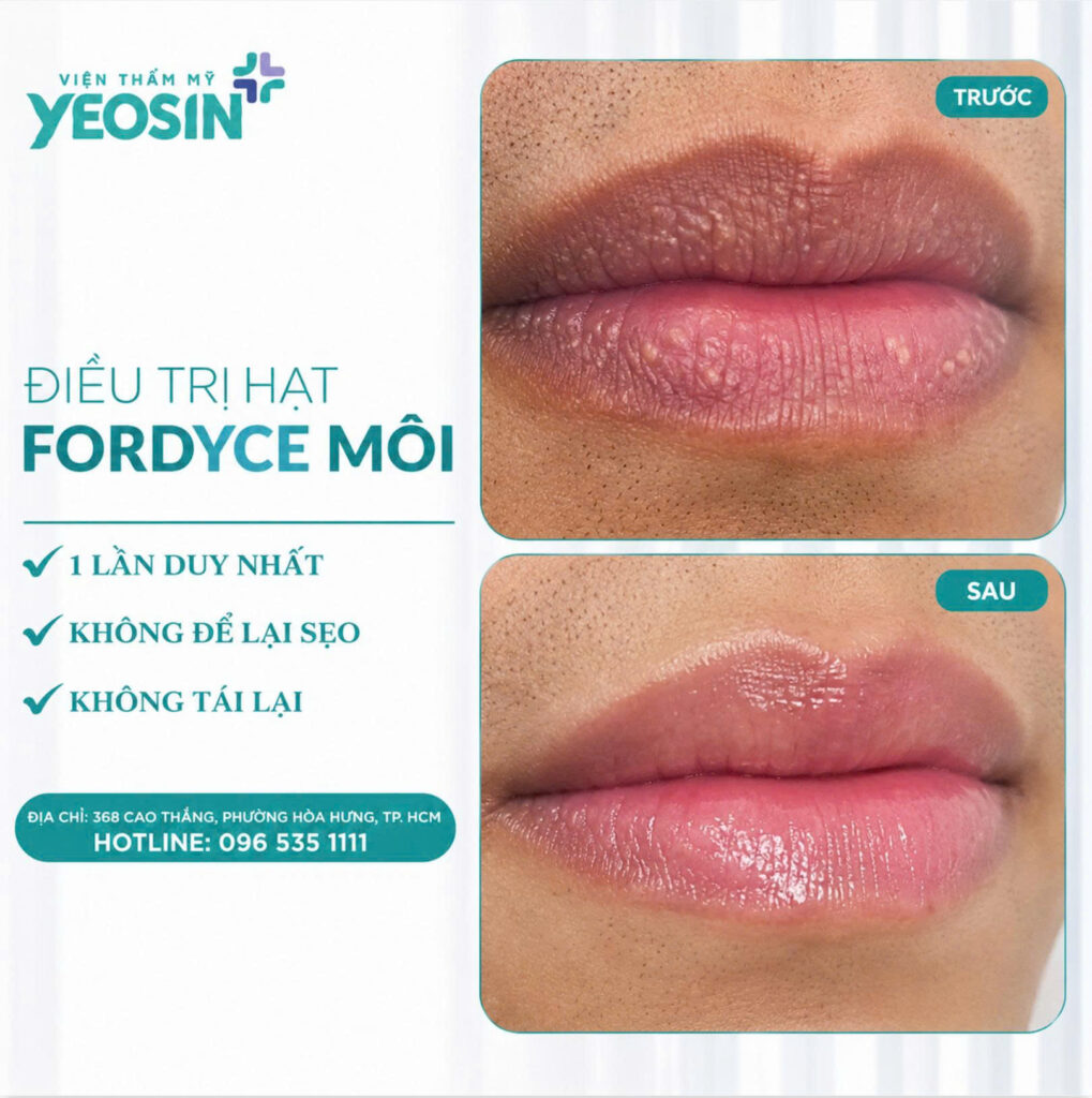 Dieu tri hat fordyce moi 2