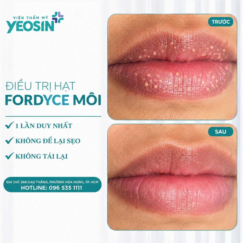Dieu tri hat fordyce moi 3