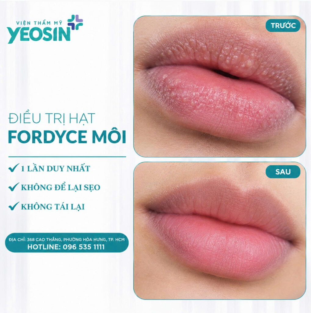 Dieu tri hat fordyce moi 4