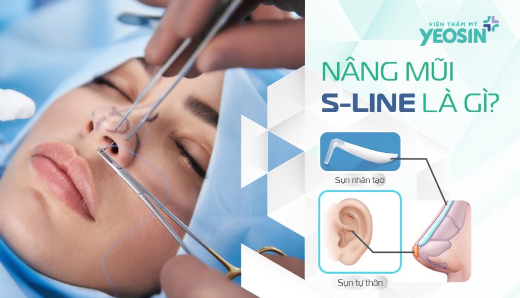 Nâng mũi S Line là gì?