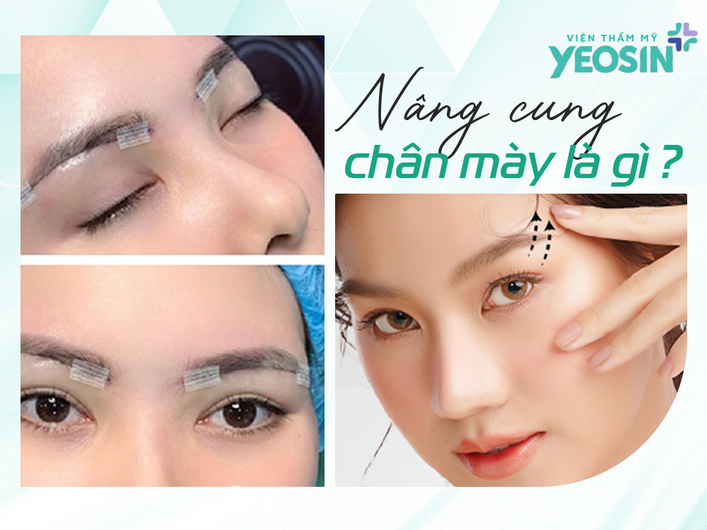 #5 kỹ thuật nâng cung chân mày phổ biến hiện nay 11 HINH MUC 1 7