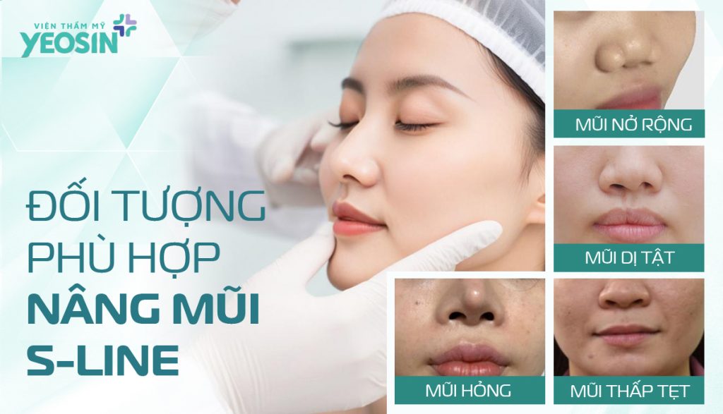 Nâng mũi S-line phù hợp với những đối tượng nào?