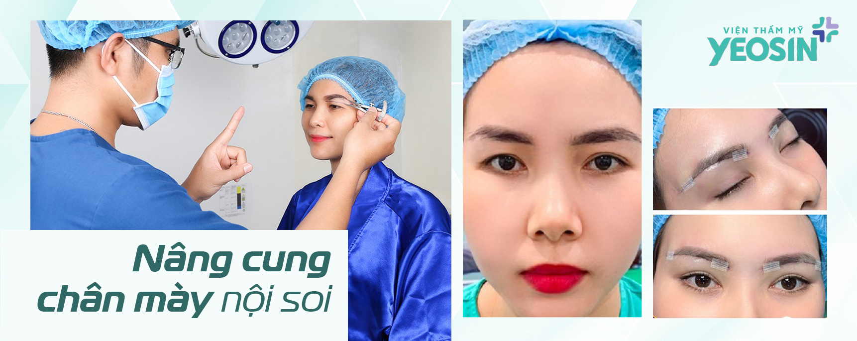 #5 kỹ thuật nâng cung chân mày phổ biến hiện nay 12 HINH MUC 2.1 1