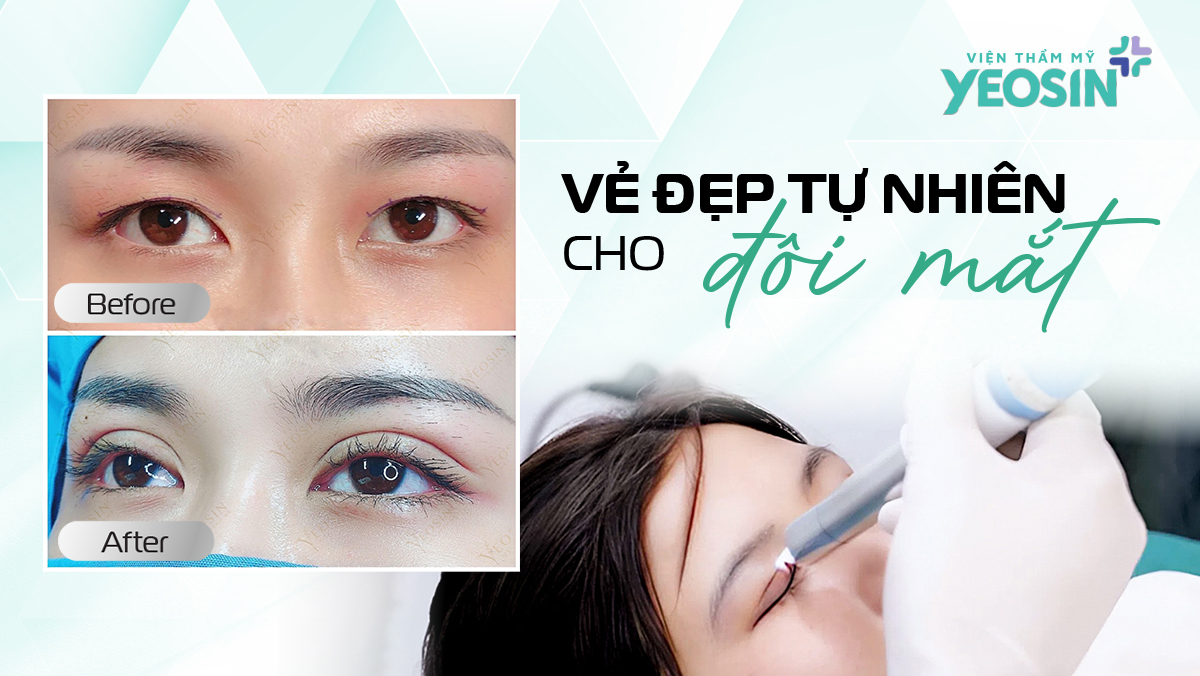Cắt Mí Bằng Công Nghệ Eyes Plasma Có An Toàn Không? 8 HINH MUC 2
