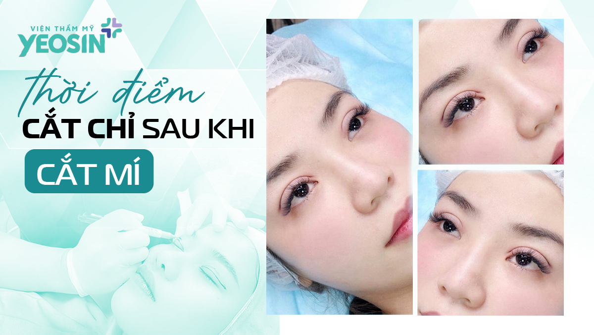 Cắt Mí Bằng Công Nghệ Eyes Plasma Có An Toàn Không? 9 HINH MUC 3