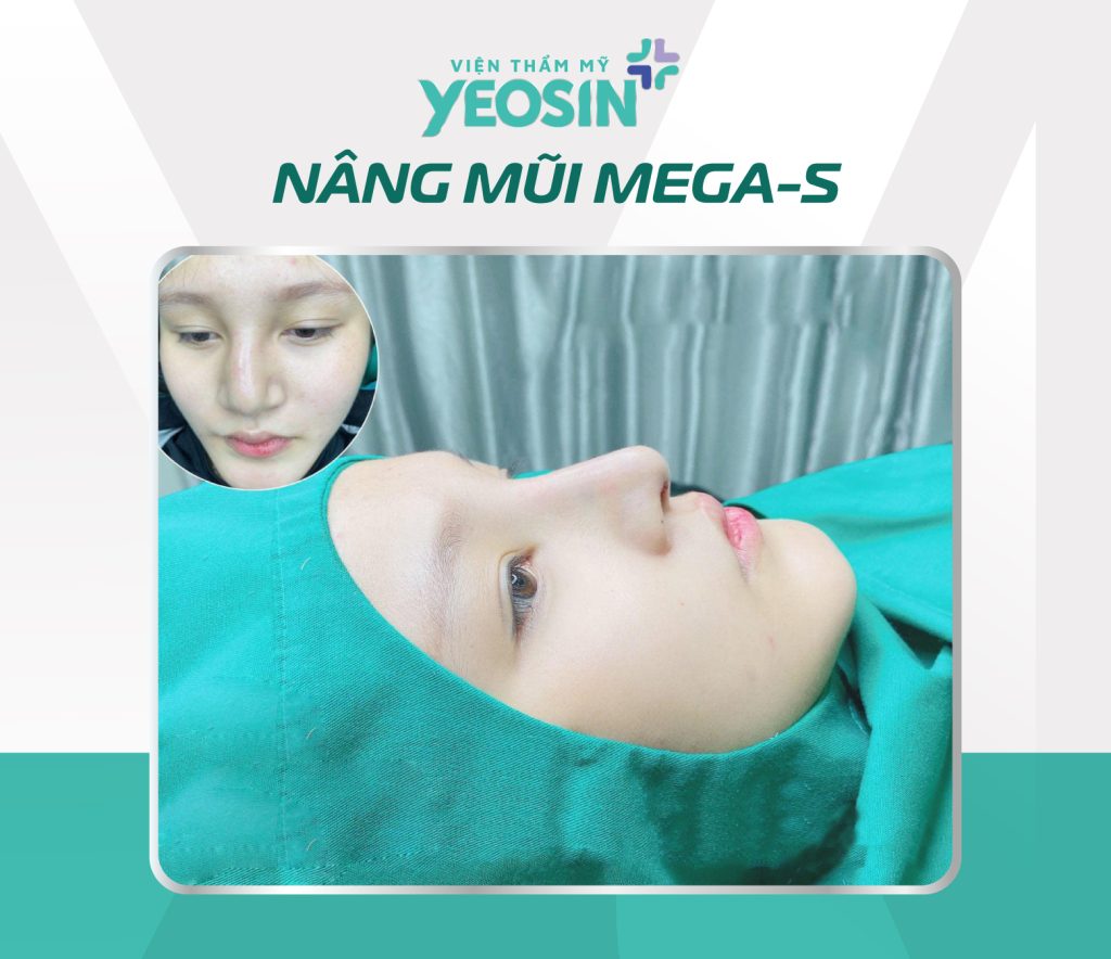 Hình ảnh trước và sau khi nâng mũi tại Viện Thẩm Mỹ Yeosin