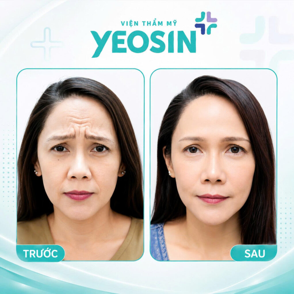 Hinh anh truoc va sau khi xoa nep nhan hieu qua tai Vien Tham My Yeosin 1 1