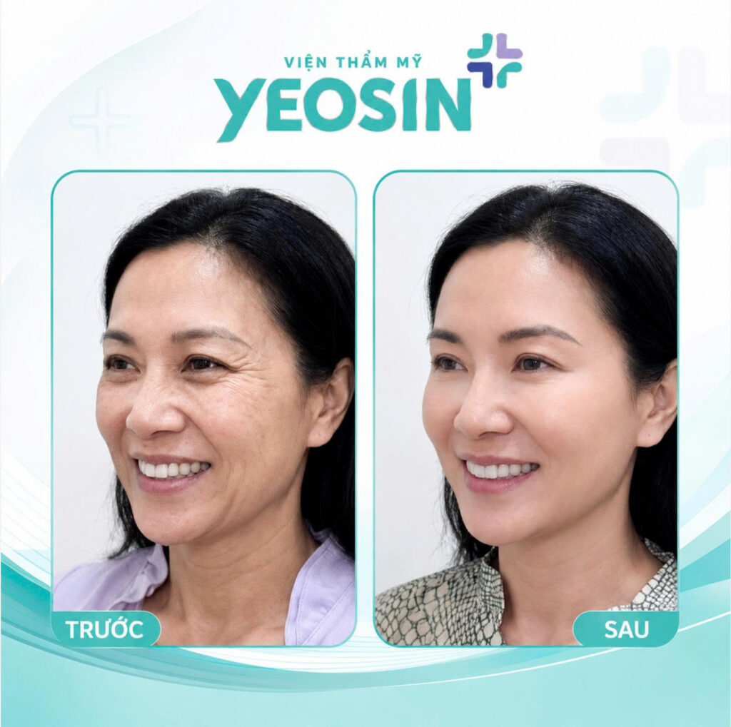 Hinh anh truoc va sau khi xoa nep nhan hieu qua tai Vien Tham My Yeosin 1