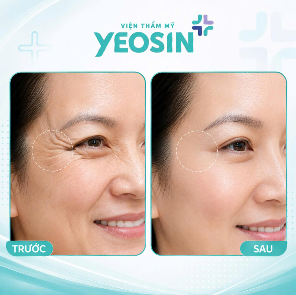 Hinh anh truoc va sau khi xoa nep nhan hieu qua tai Vien Tham My Yeosin
