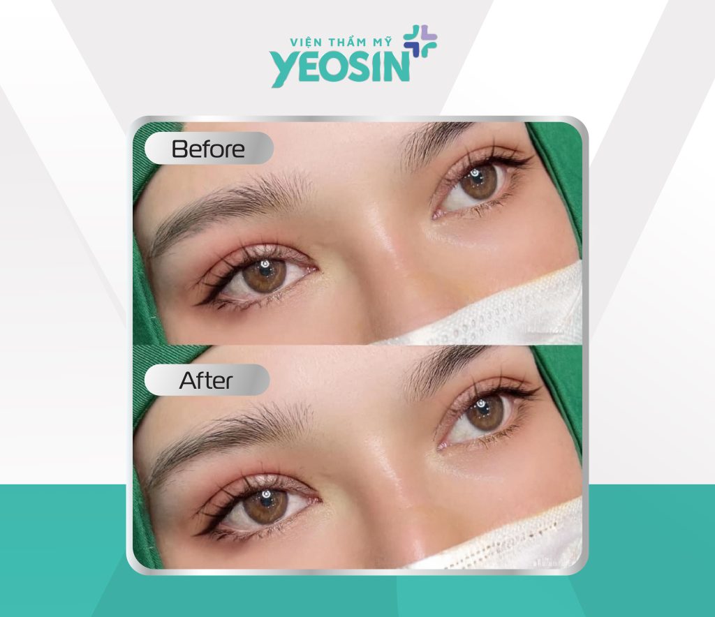 Hình trước sau cắt mí công nghệ eye plasma hiệu quả tại yeosin