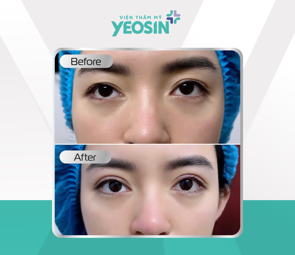 Hình trước sau cắt mí công nghệ eye plasma hiệu quả tại yeosin