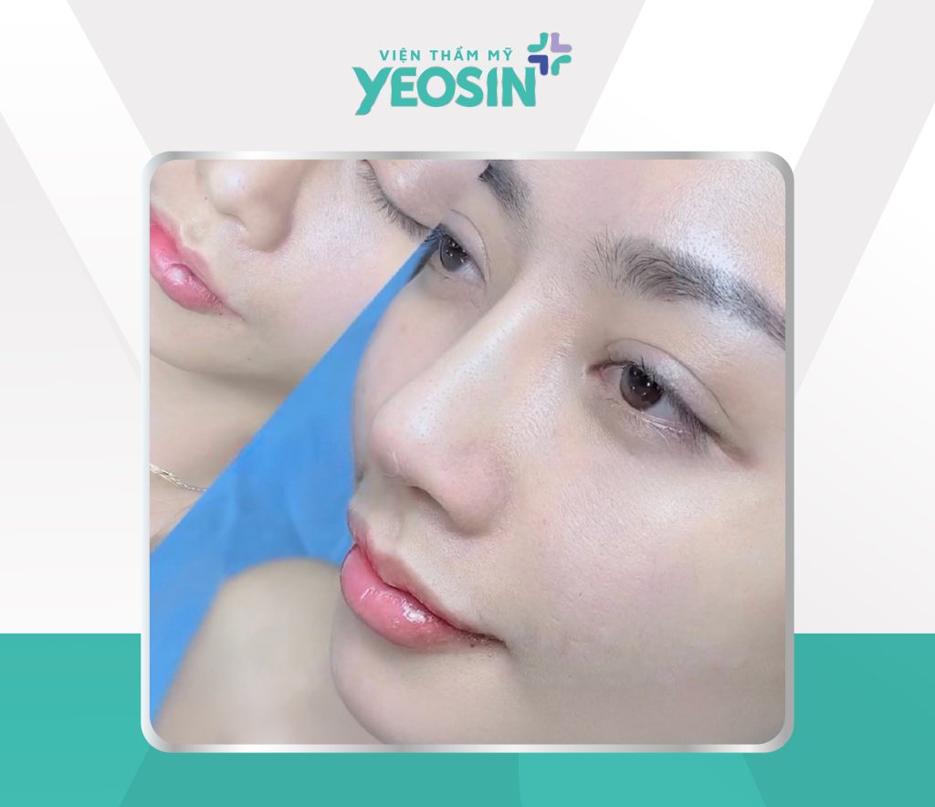 Hình ảnh khách hàng nâng mũi bằng chỉ collagen tại Yeosin