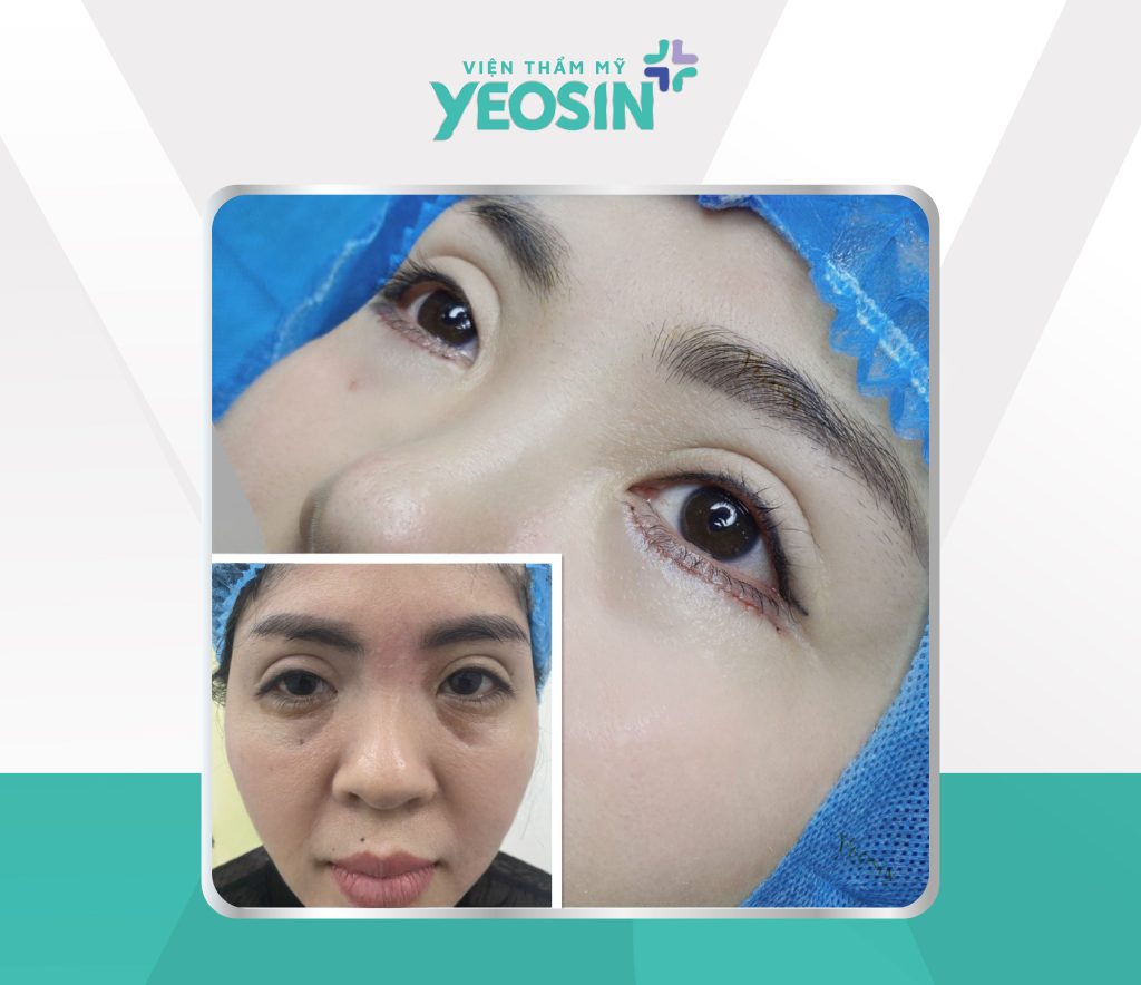 Hình trước sau 08