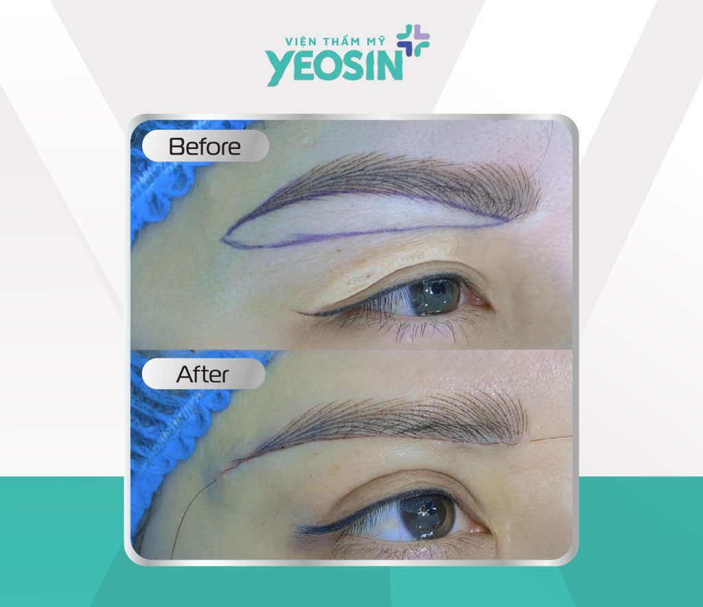 Hình ảnh khách hàng nâng cung chân mày hiệu quả tại Yeosin