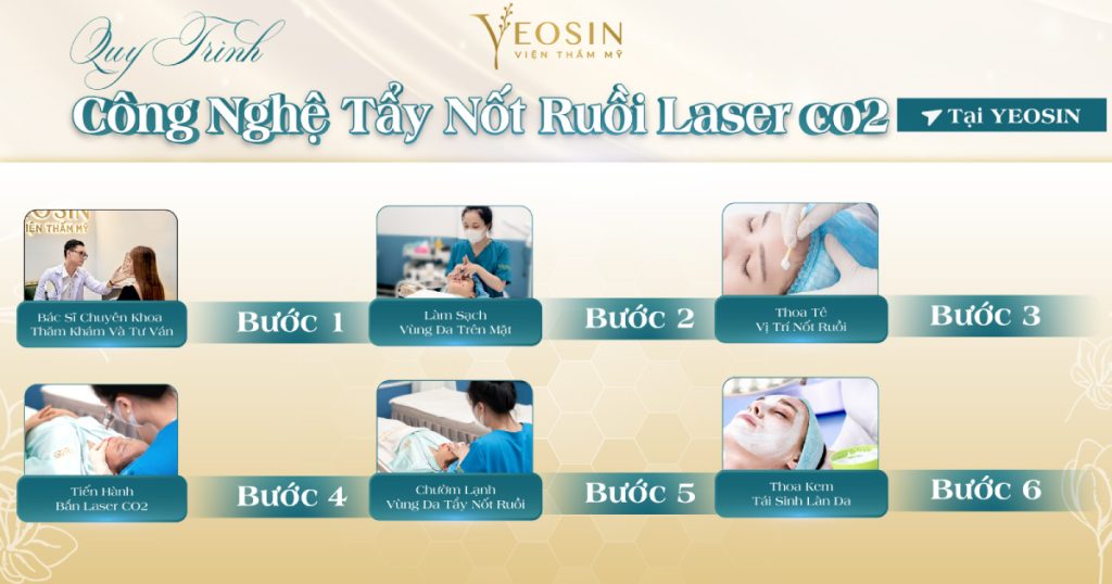 Quy trình xóa nốt ruồi bằng laser chuẩn y khoa