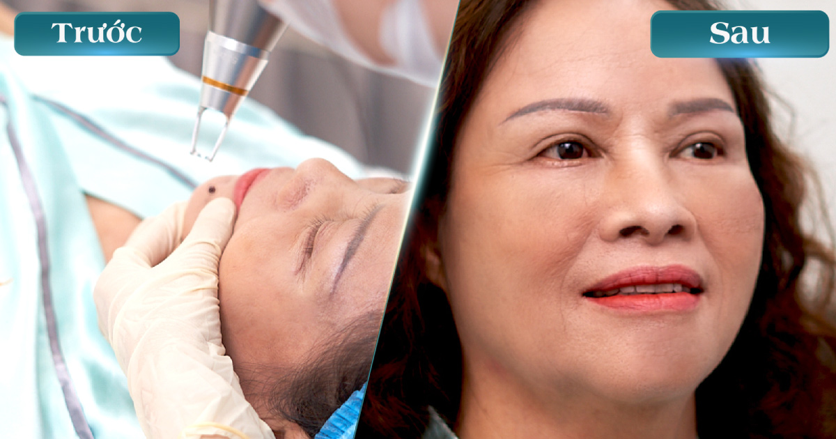 Tẩy Nốt Ruồi Bằng Công Nghệ Laser CO2: Sạch Chân, Không Sẹo, An Toàn Tuyệt Đối