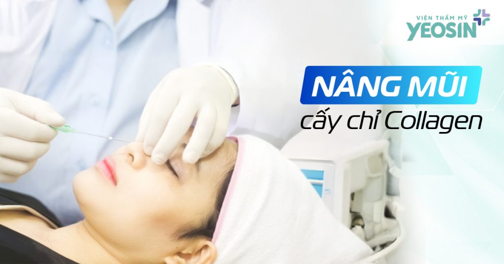 Nâng mũi bằng chỉ collagen tại Yeosin