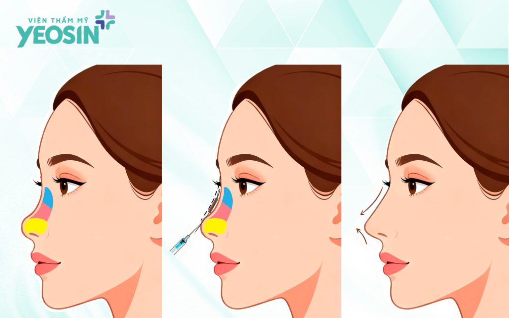Nâng mũi bằng chỉ collagen là gì?