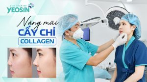 Nâng mũi bằng chỉ collagen