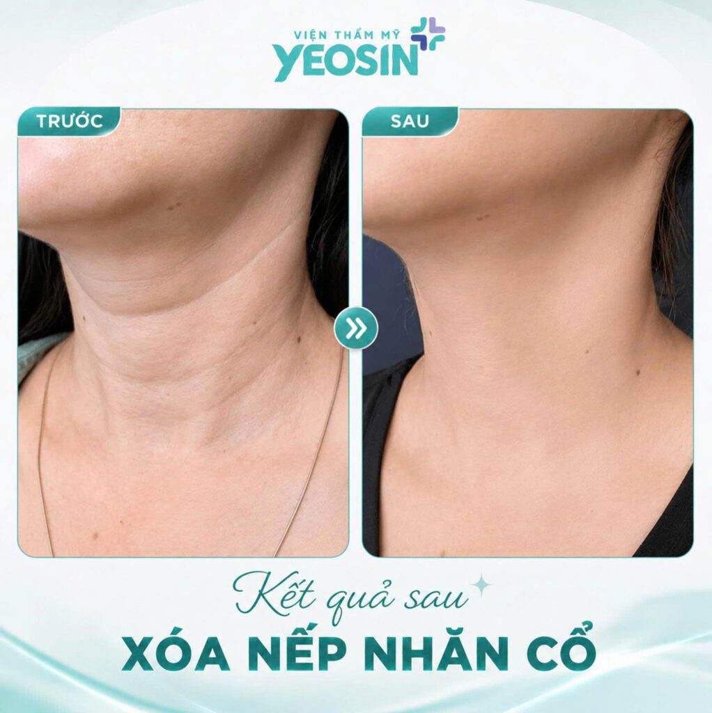 Xoa nep nhan co 1