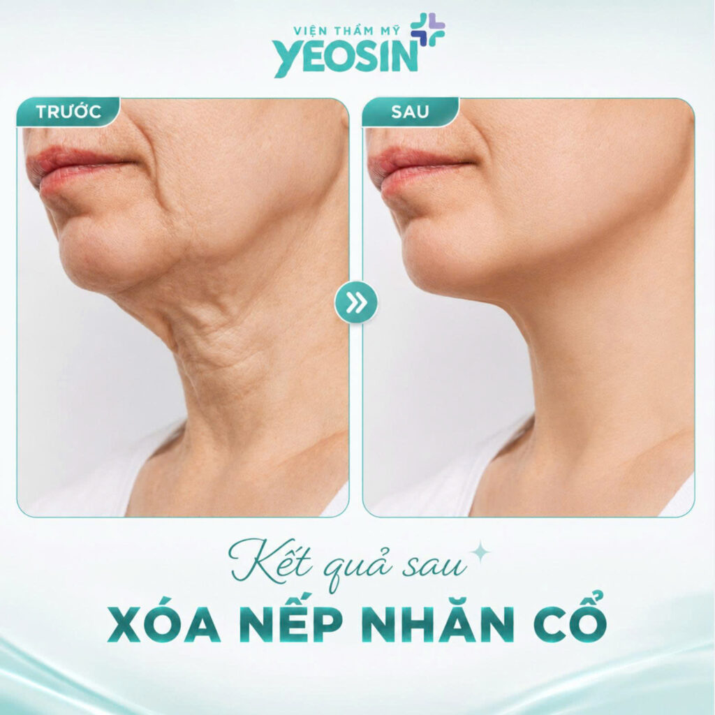 Xoa nep nhan co