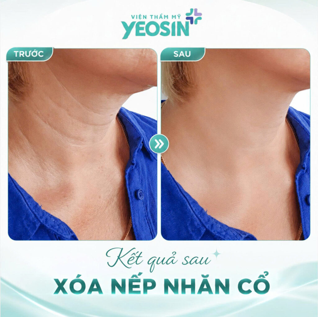 Xoa nep nhan co 2 1